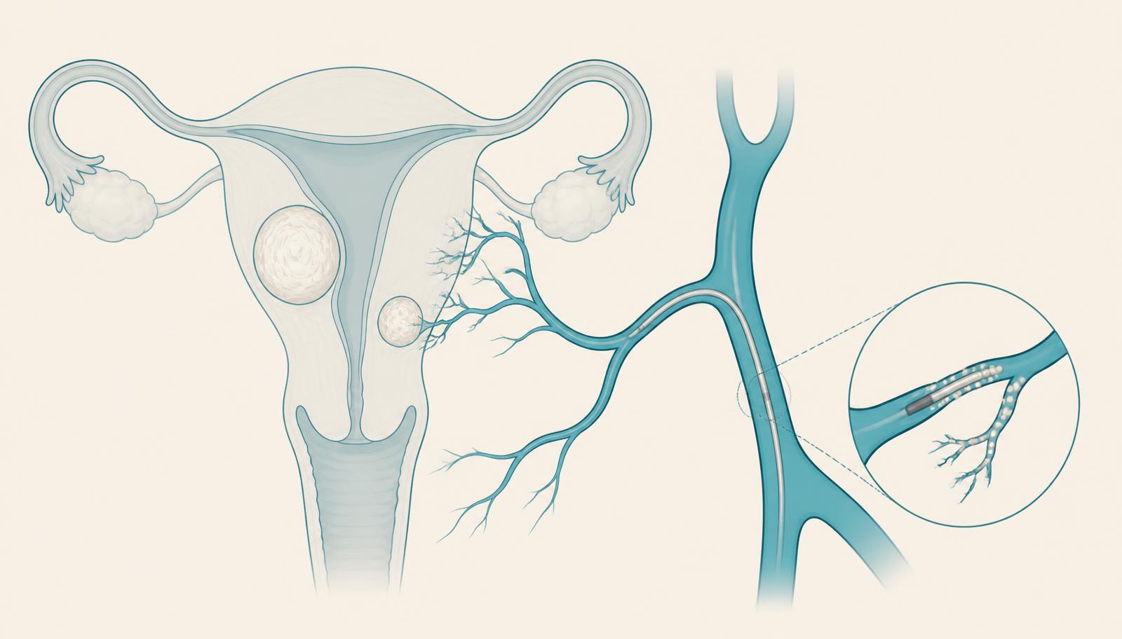 Illustrazione dell'utero con fibromi e catetere in arteria uterina per l'embolizzazione