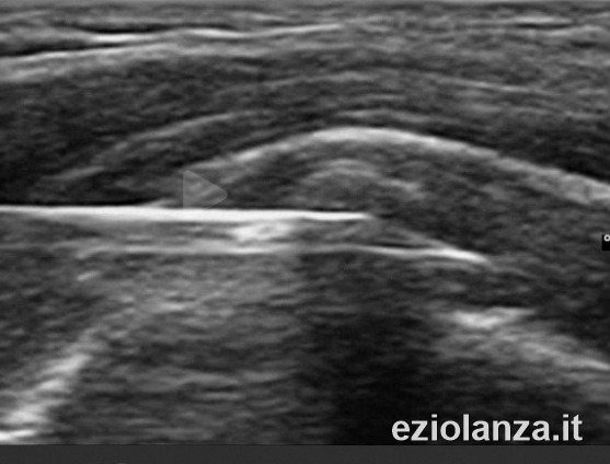 Immagine ecografica reale dell'ago durante il lavaggio ecoguidato (litoclasia) di una calcificazione del tendine della cuffia dei rotatori